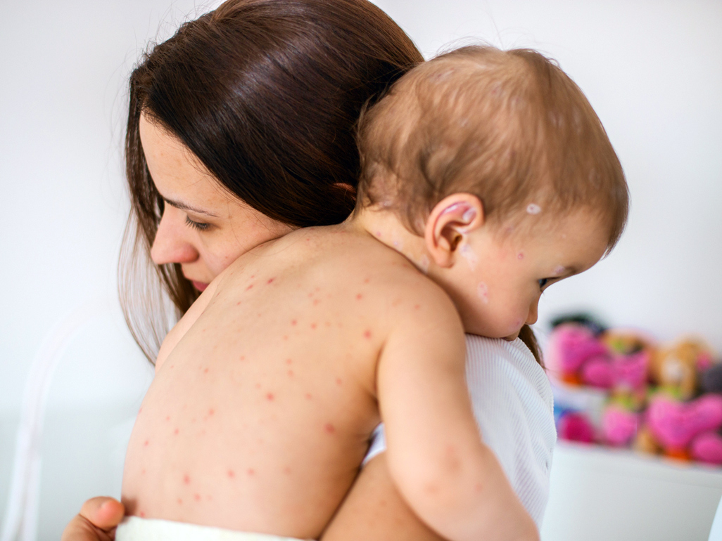 Mum holding baby with chickenpox