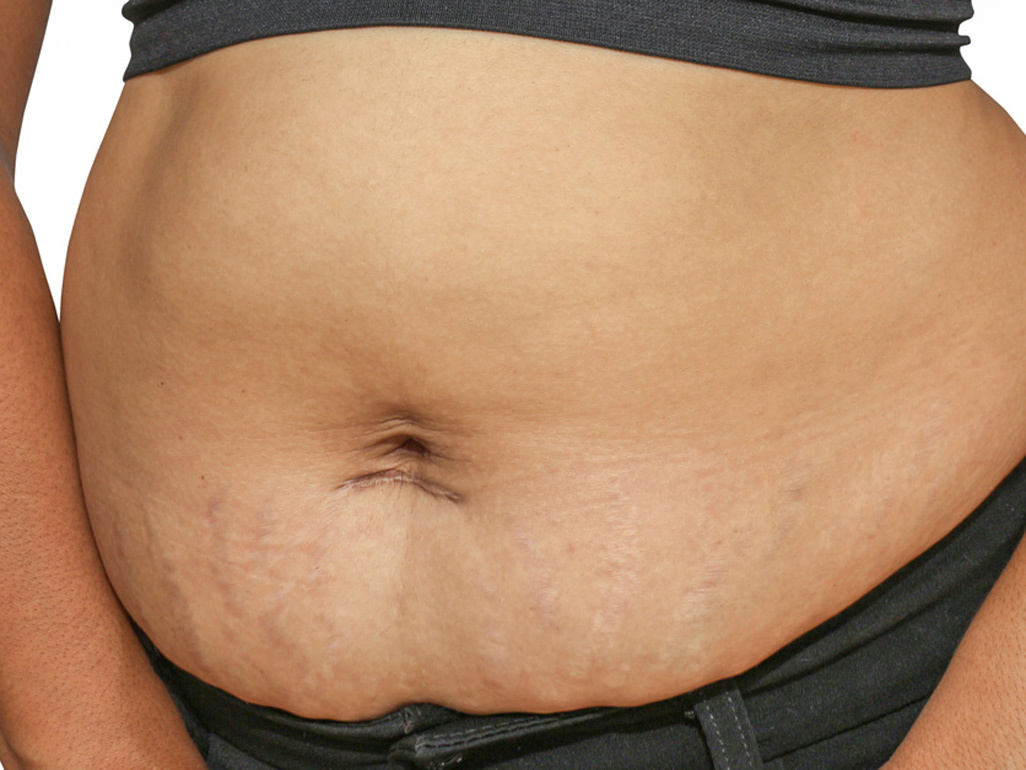 Post-pregnancy belly