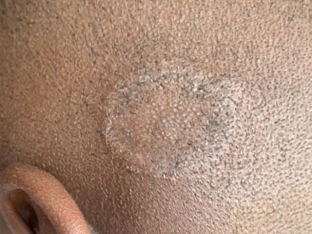 Ringworm rash