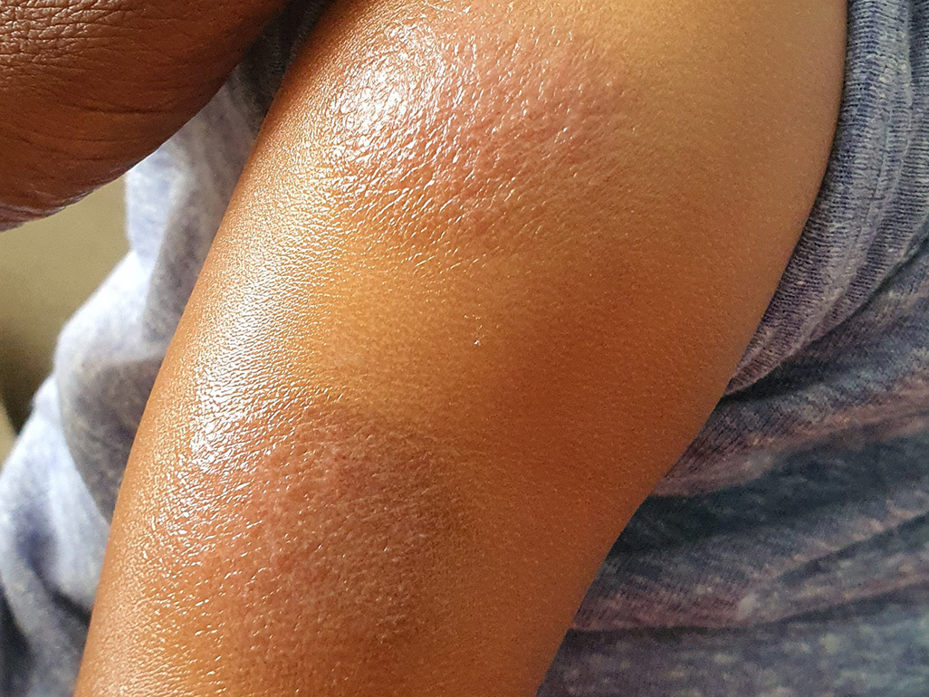 Picture of ringworm