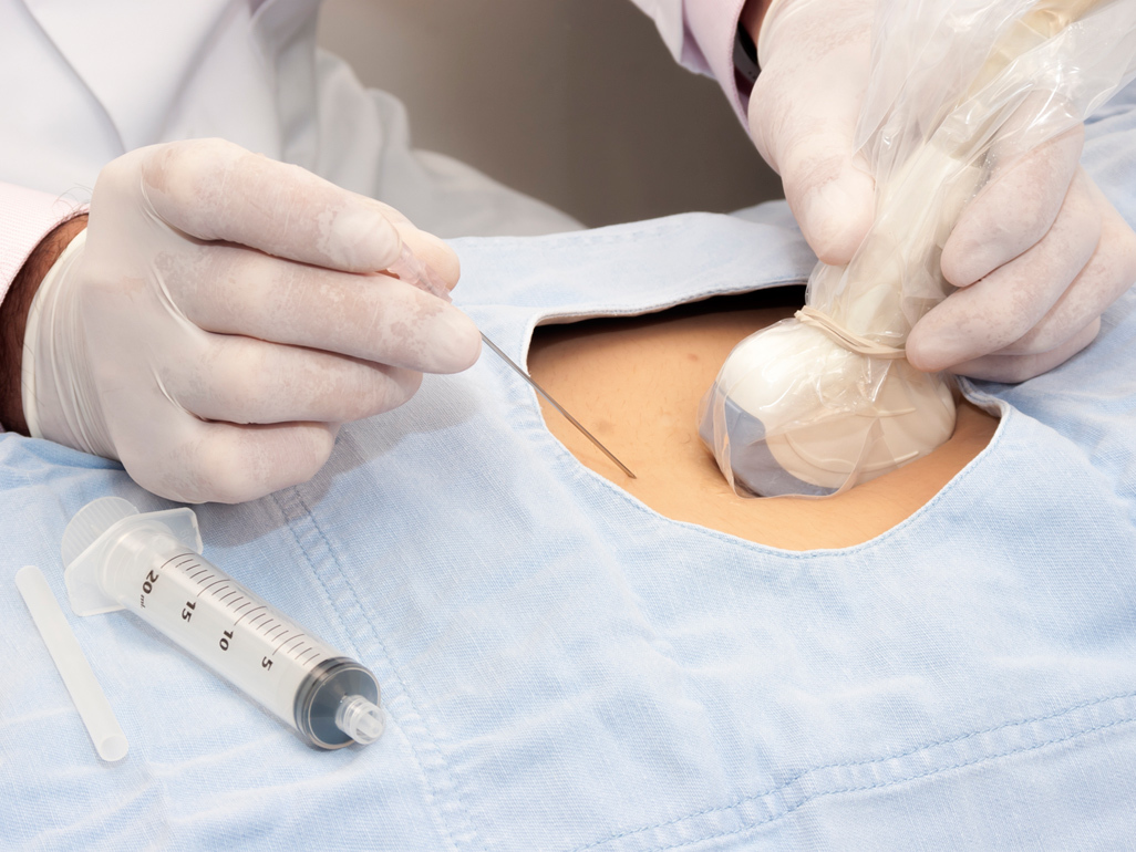Close-up of CVS procedure