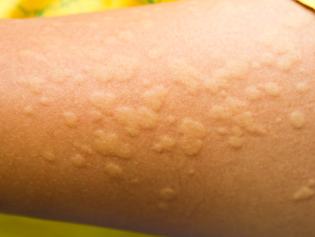 Hives (urticaria) rash