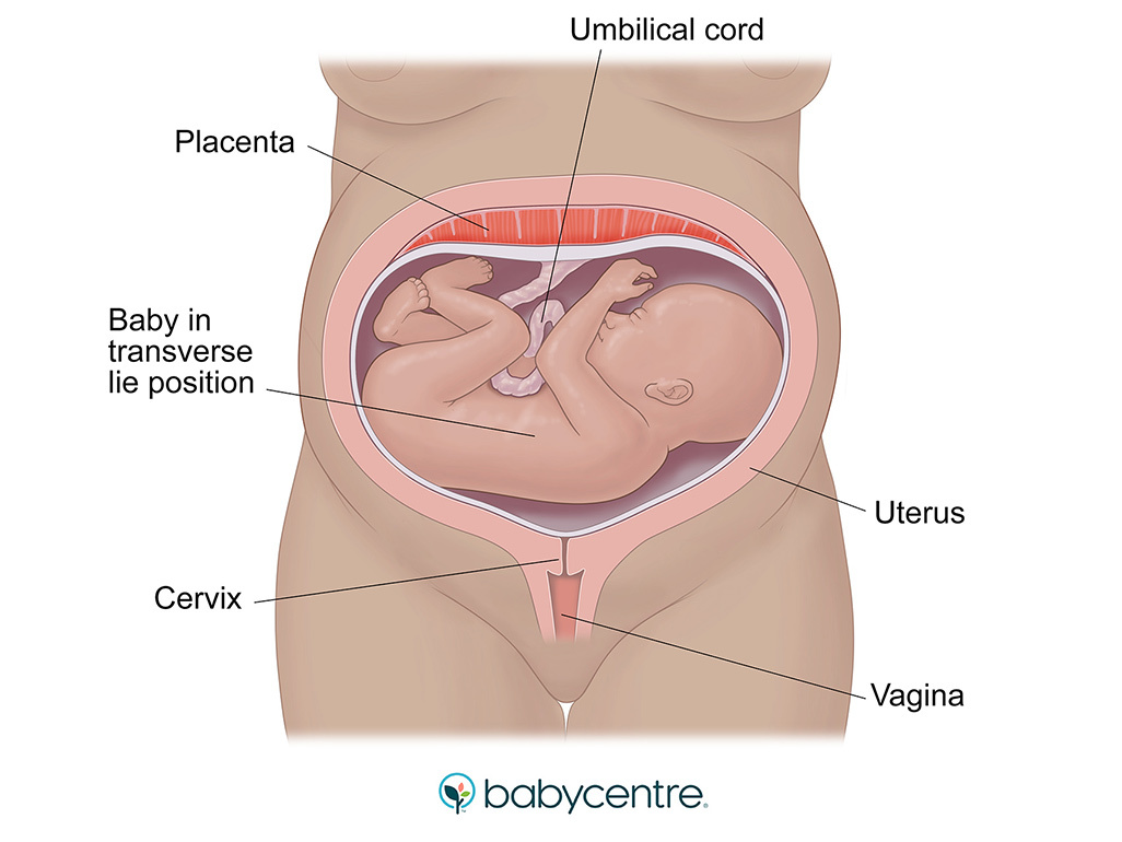 Baby in transverse lie position
