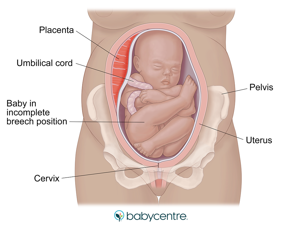 Baby in incomplete breech position